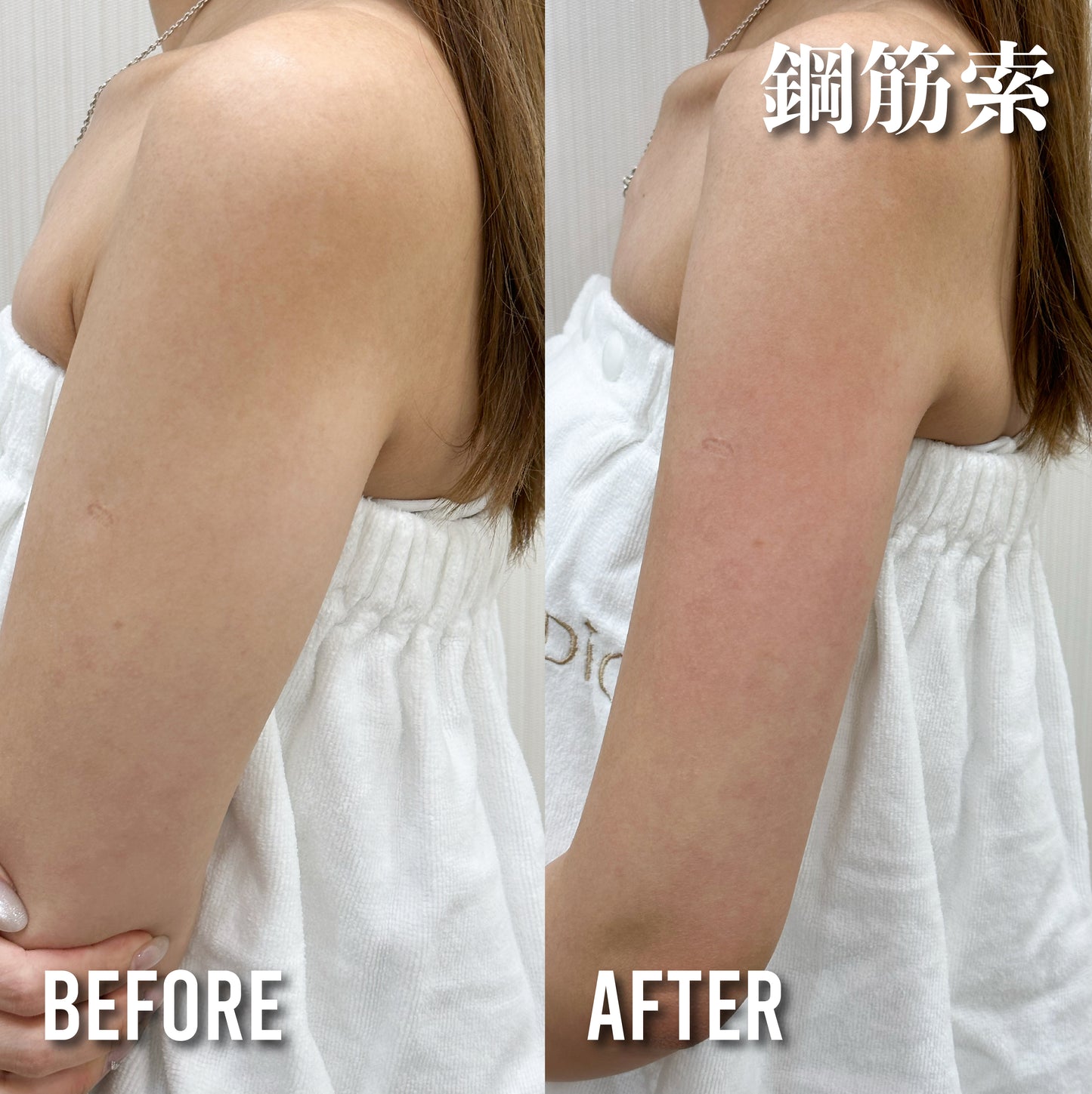 HIFU線雕手臂(單次)
