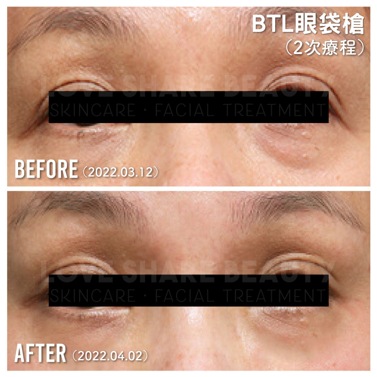 BTL彈力緊緻雞蛋肌療程(單次)