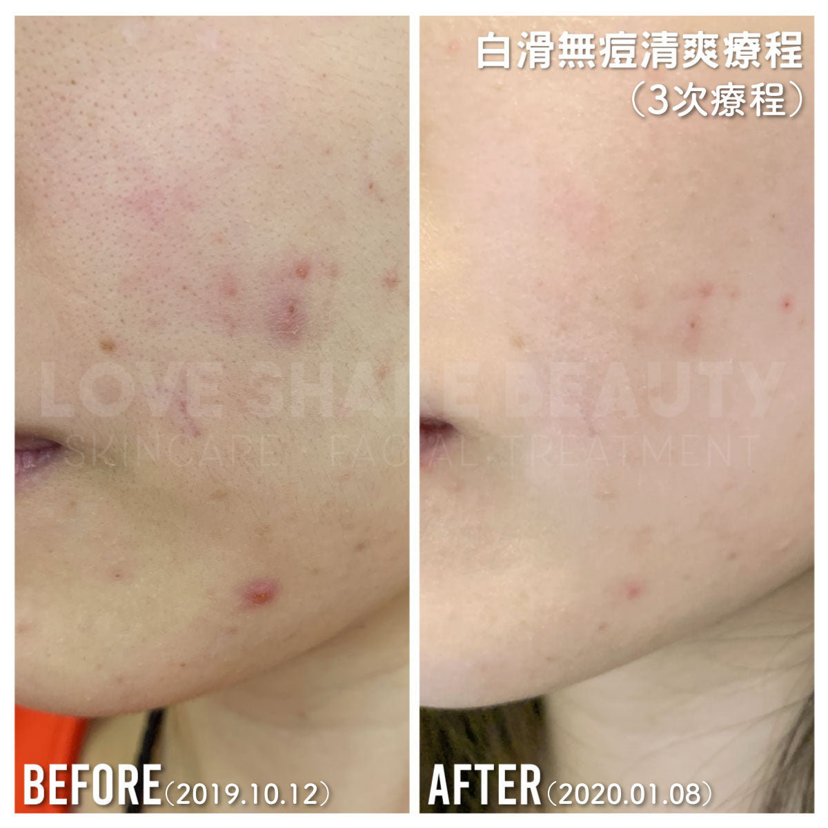 白滑無痘清爽療程(單次)